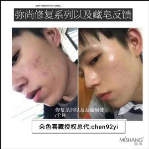 适合学生用的祛痘产品?藏皂祛痘效果真的好吗? 适合学生用的祛痘产品?藏皂祛痘效果真的好吗?