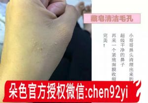 微商护肤品哪个好祛痘?喜藏藏皂效果? 微商护肤品哪个好祛痘?喜藏藏皂效果?
