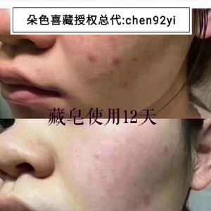 很多人都在用藏皂?藏皂有真实去痘反馈吗? 很多人都在用藏皂?藏皂有真实去痘反馈吗?