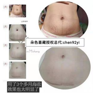 微商朵色海盐能去妊娠纹吗?有反馈吗? 微商朵色海盐能去妊娠纹吗?有反馈吗?